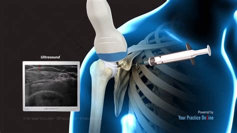 Shoulder injection cpt code. Things To Know About Shoulder injection cpt code. 